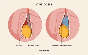 Does Hitting the Gym Lead to Varicocele? Unveiling the Truth Behind the Connection
