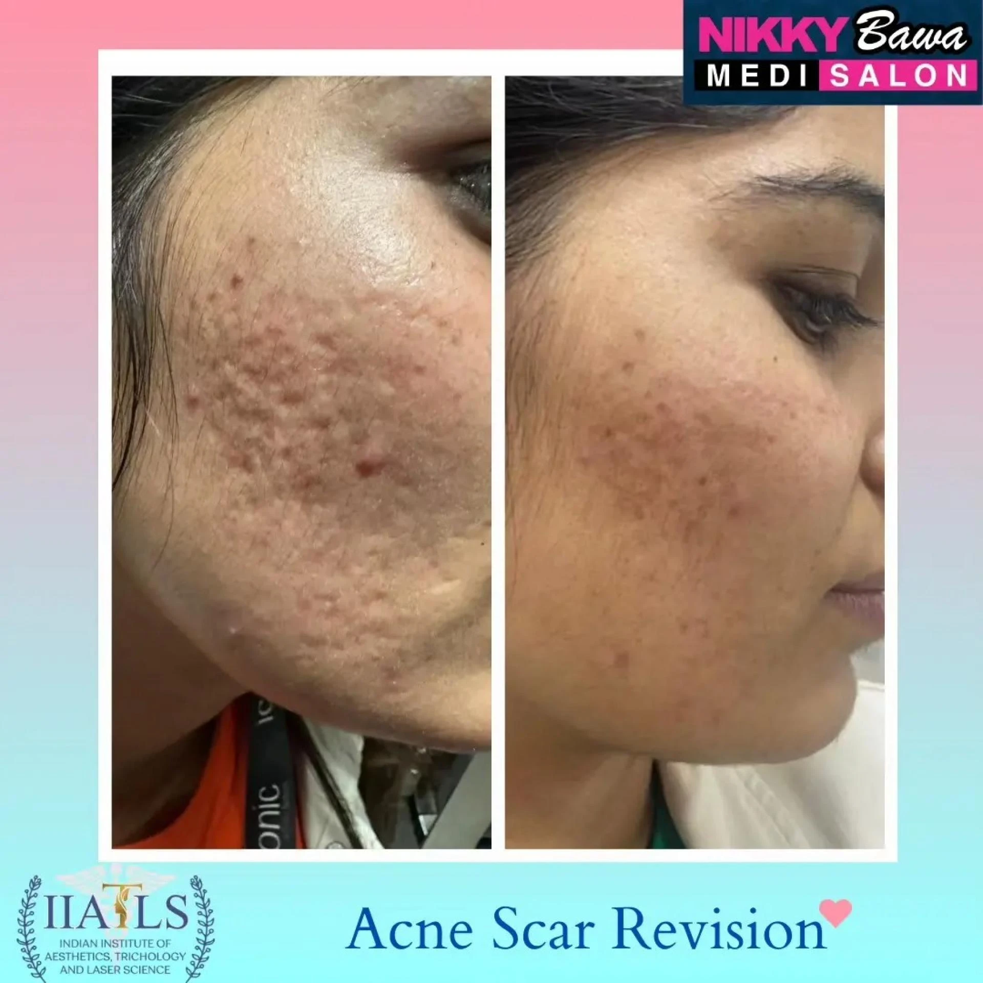 Best Acne Scar Treatments Available at Skin Care Clinics in Bhopal