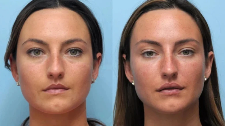 Thread Lift Treatment in Dubai The Ultimate Skin Rejuvenation Option