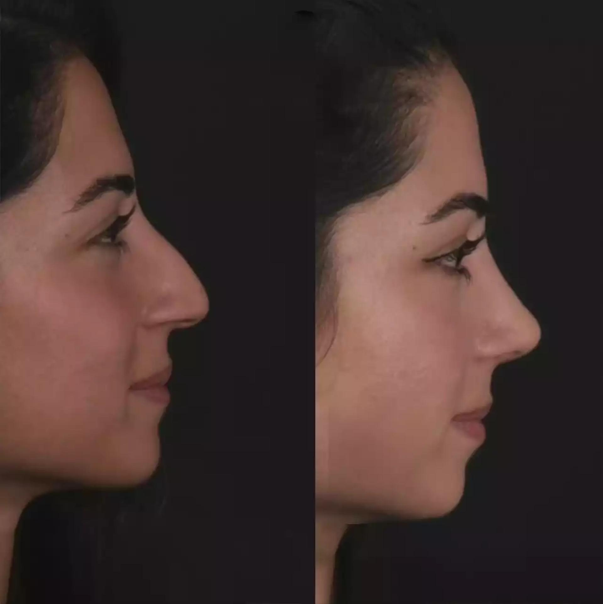 Revision Rhinoplasty in Dubai: Fixing a Previous Nose Job