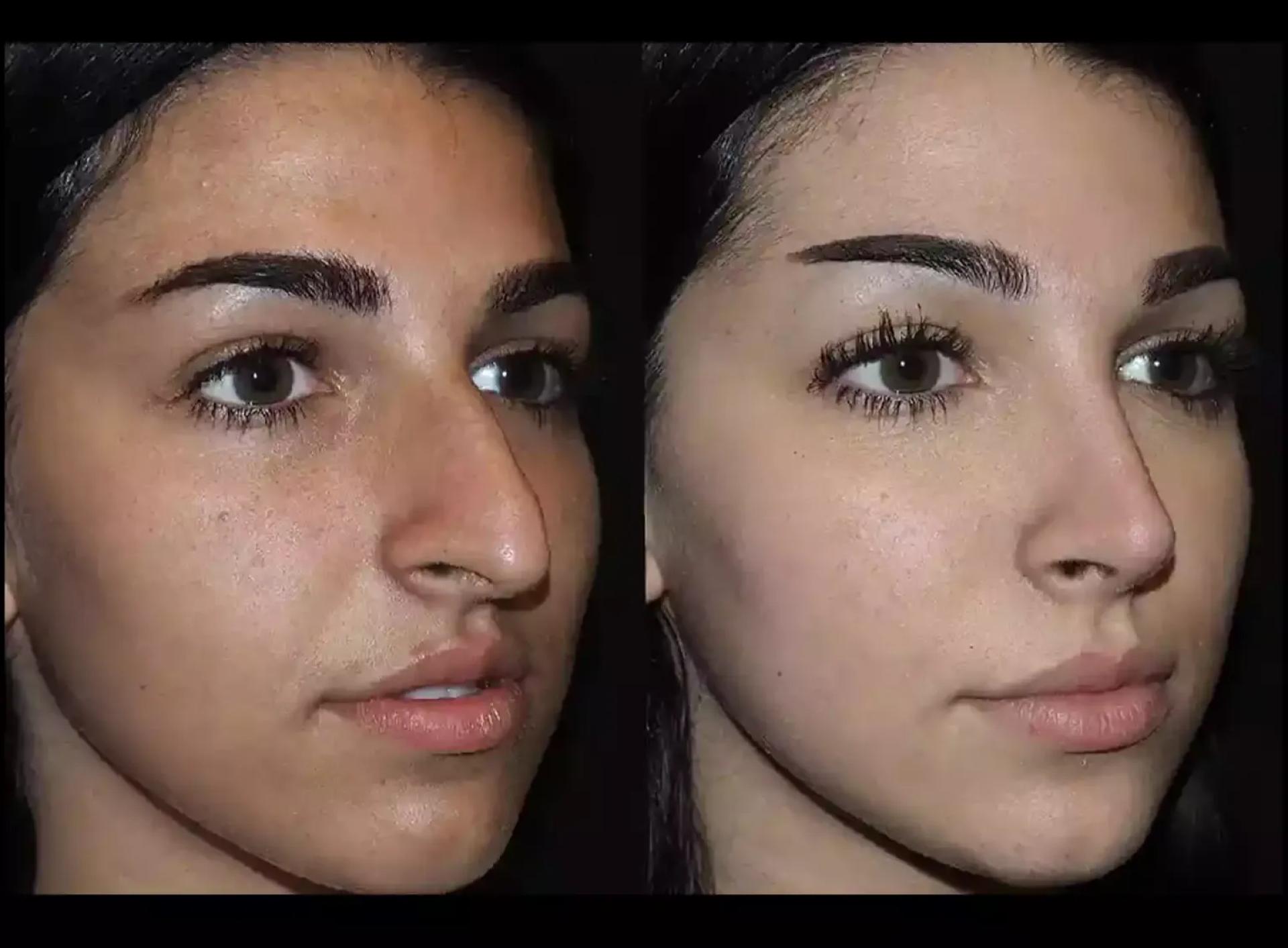 Septoplasty in Dubai for Deviated Septum: Symptoms and Solutions