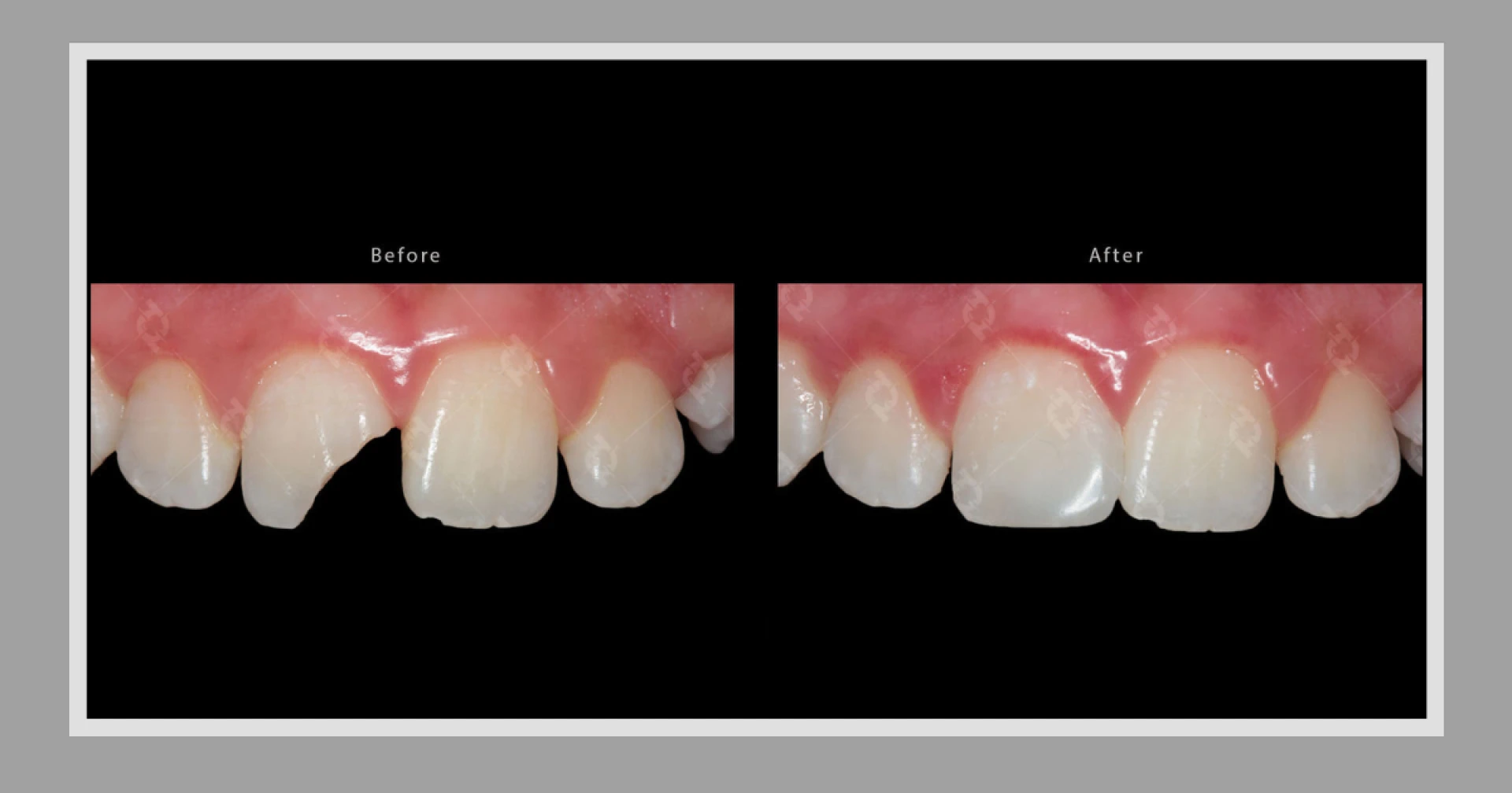 Can Fixed Bridge Dental Implants Be Customized for a Natural Look?
