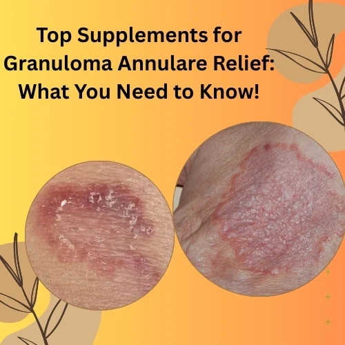 Top Supplements for Granuloma Annulare Relief: What You Need to Know!