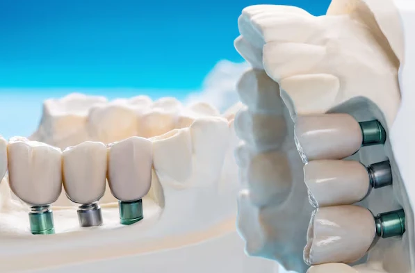 Dental Implants: Benefits for Smile, Bone Health and Function