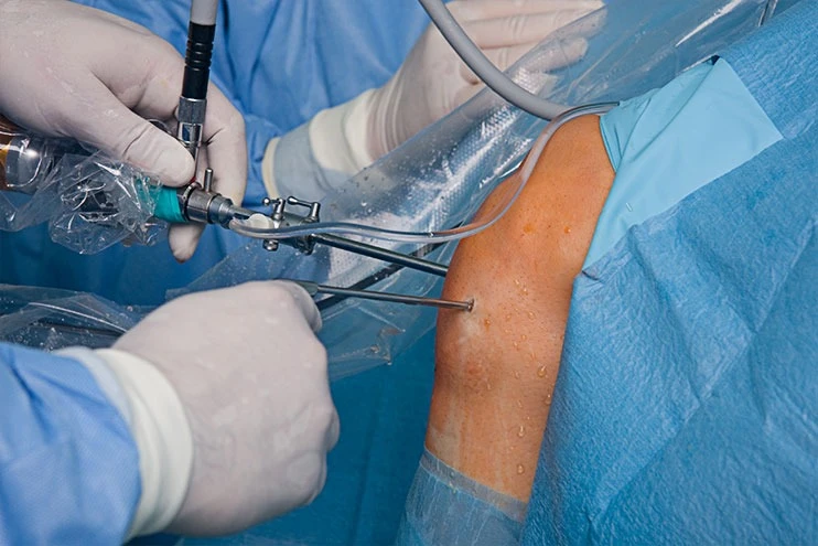 Heal Faster with Less Pain: Arthroscopy Surgery in Delhi
