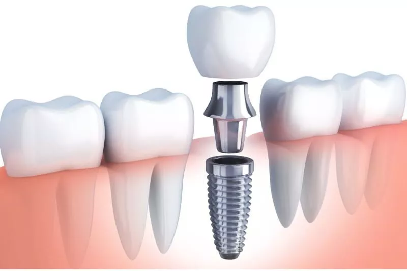  Dental Implants and Bone Health: What Leesburg Residents Need to Know