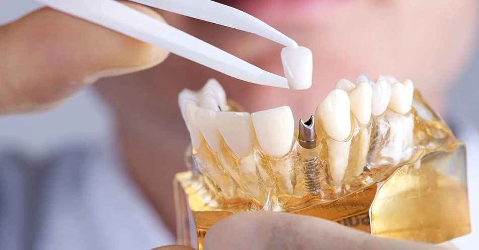 A Complete Guide to Dental Implant Services: The Way to a Lifelong Smile