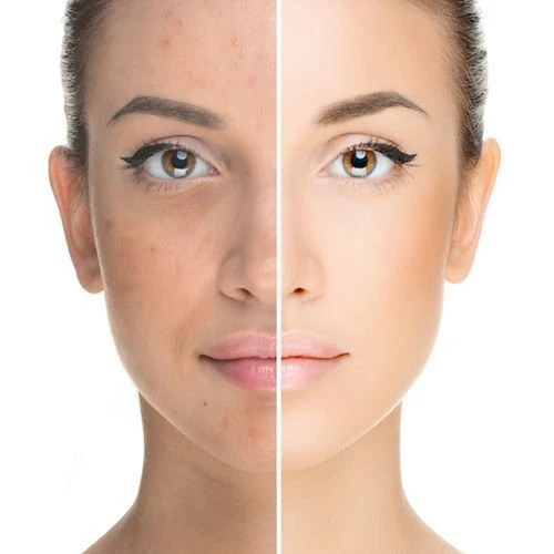 Reversing Sun Damage with Laser Skin Whitening in Islamabad