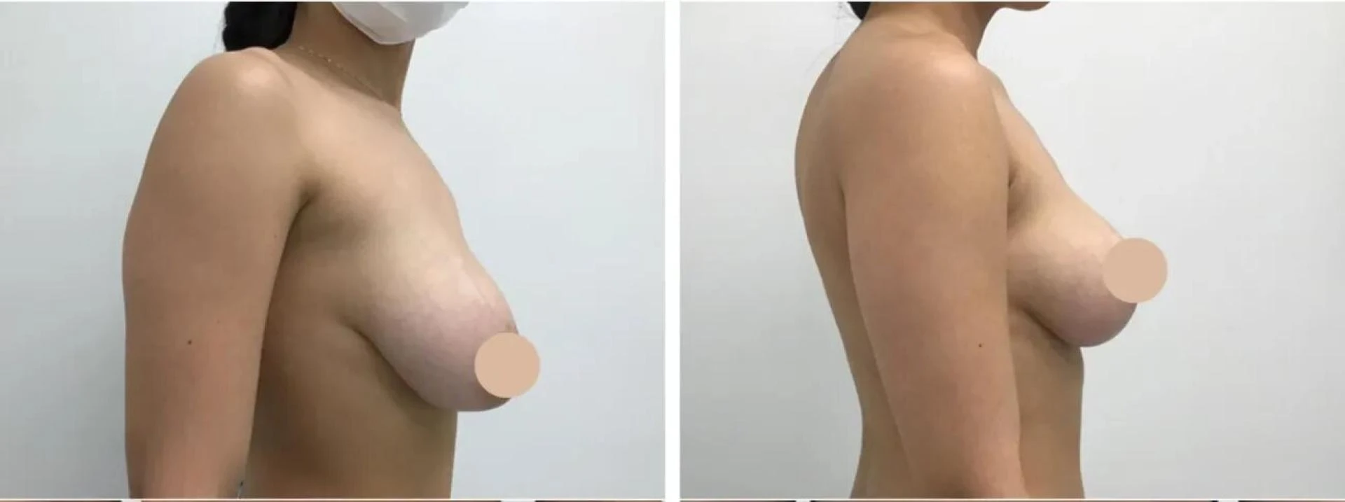 How to Assess the Qualifications of Best Breast Lift Surgeons in dubai