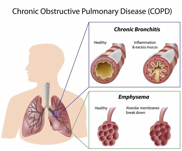 Chronic Bronchitis vs COPD: Are They the Same? Key Differences Explained