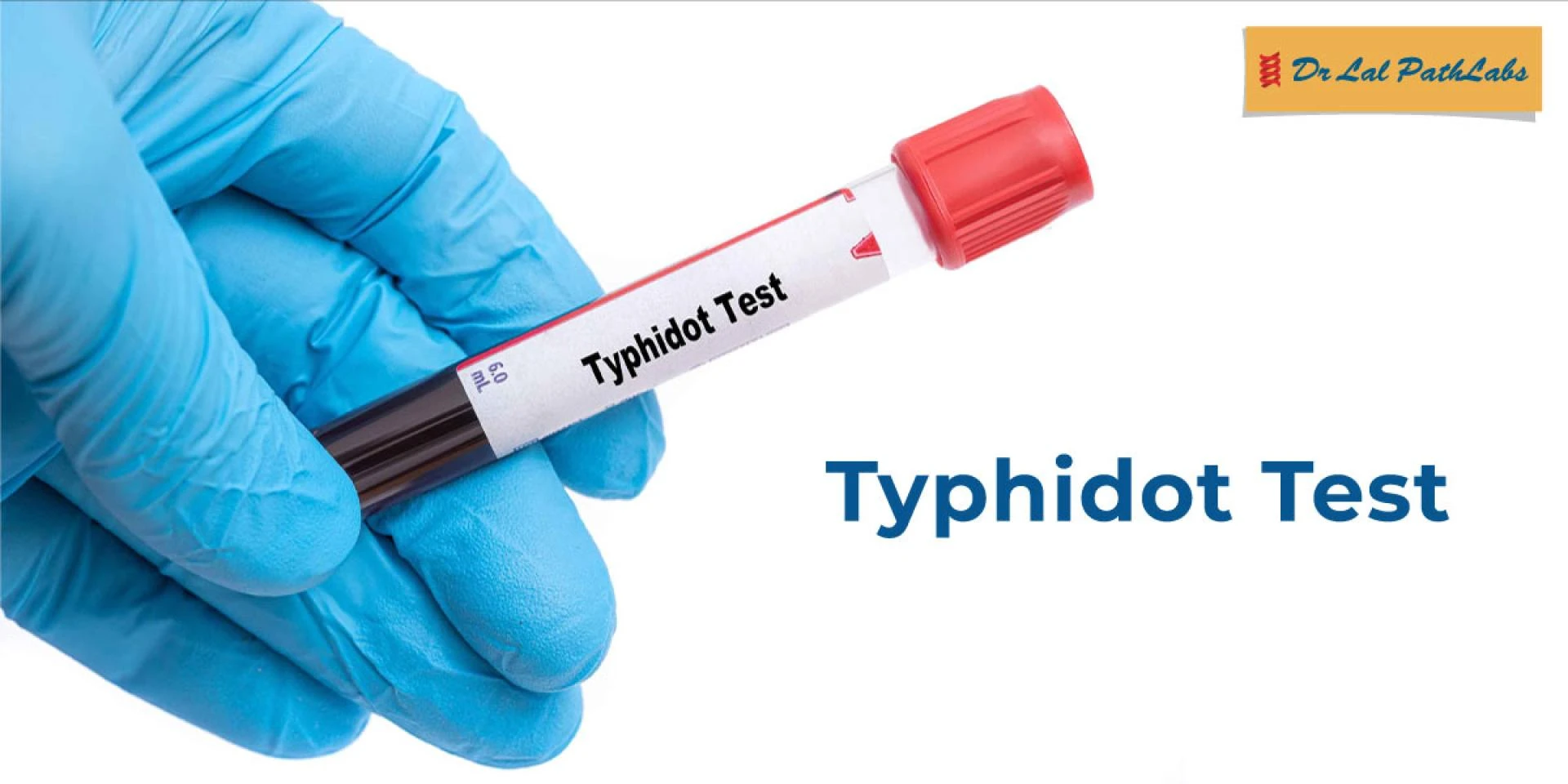 What Is the Typhidot Test? Procedure, Results & Importance