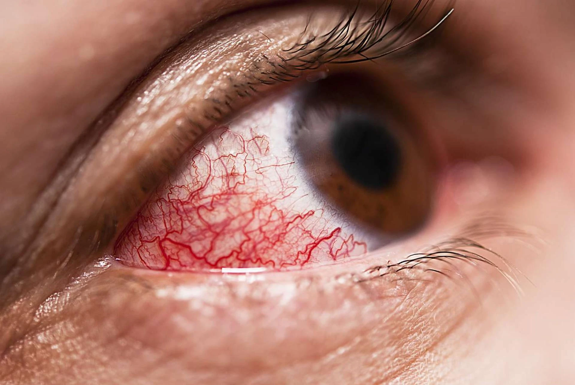How Ayurveda Treats Uveitis: A Holistic Guide to Eye Inflammation