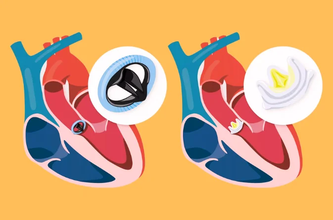 Comprehensive Guide to Aortic Valve Surgery 