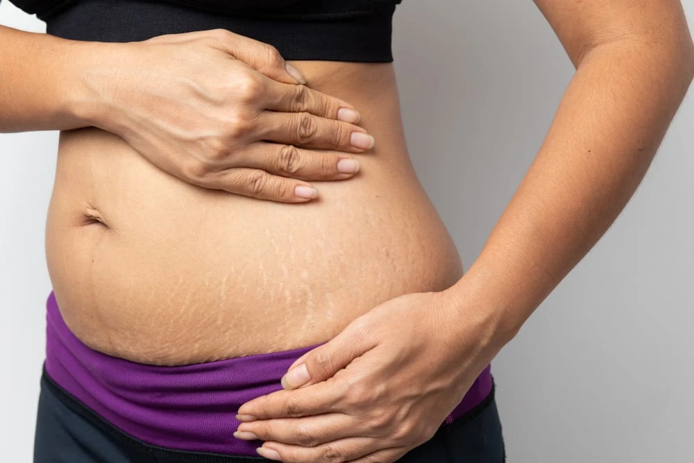 Does Tummy Tuck Surgery Fix Loose Skin?