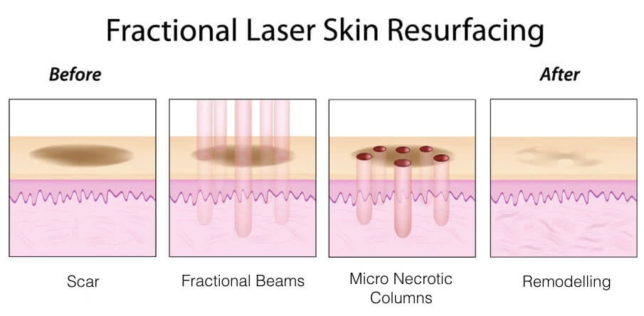 Rejuvenate and Renew: All About Fractional Resurfacing Treatment in Delhi