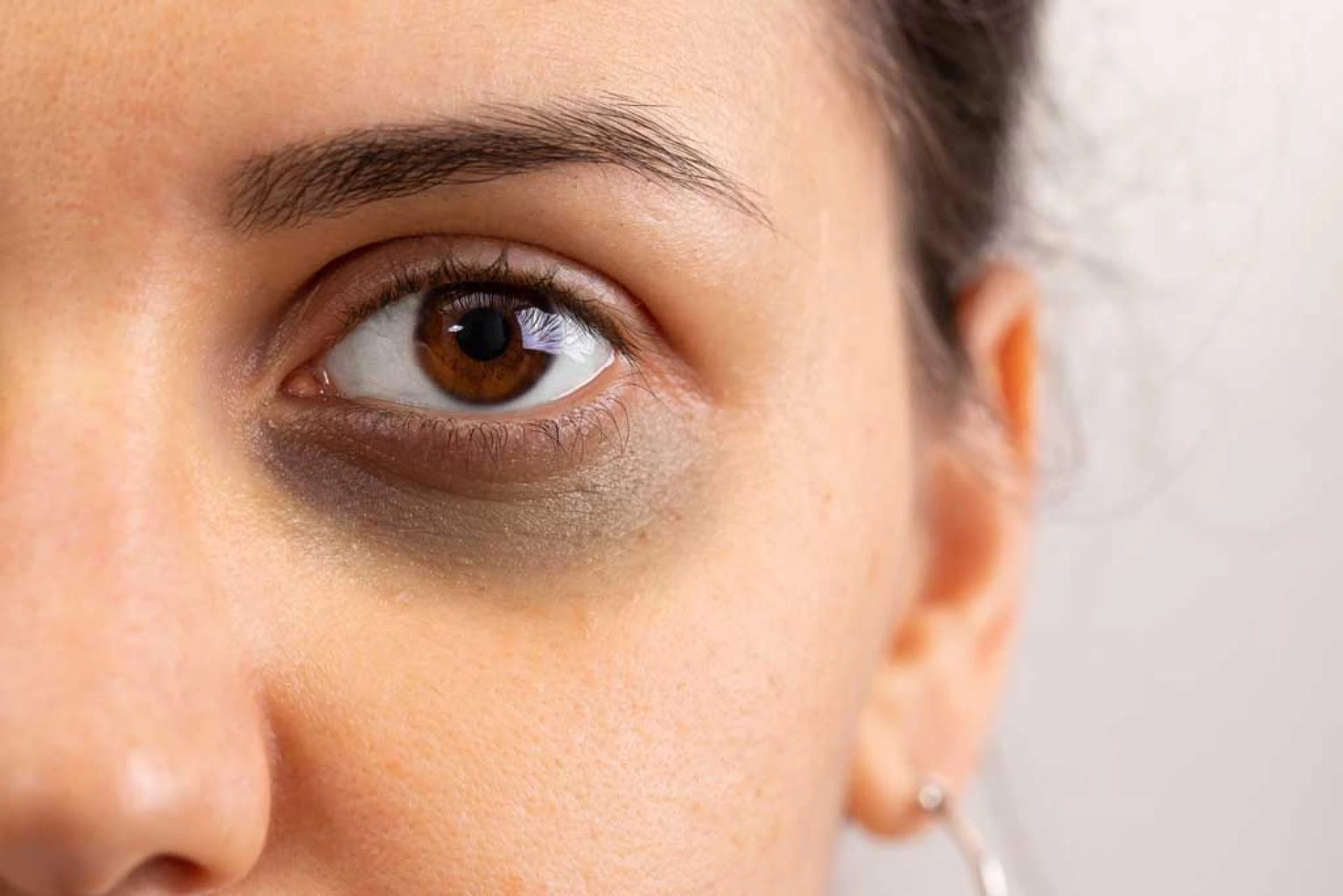 Is Your Dark Circles Treatment Working Yet?
