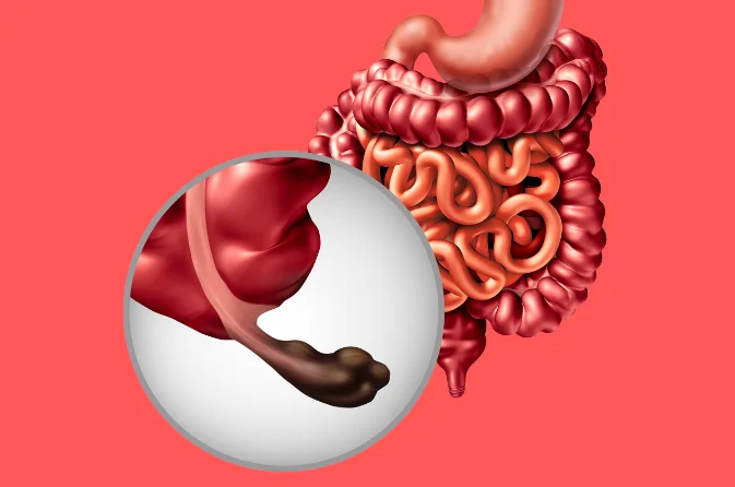 Top Appendix Surgery Hospitals Near Me for Quick Relief