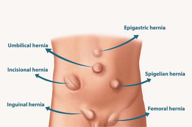 Minimally Invasive Inguinal Hernia Surgery in Mira Bhayandar