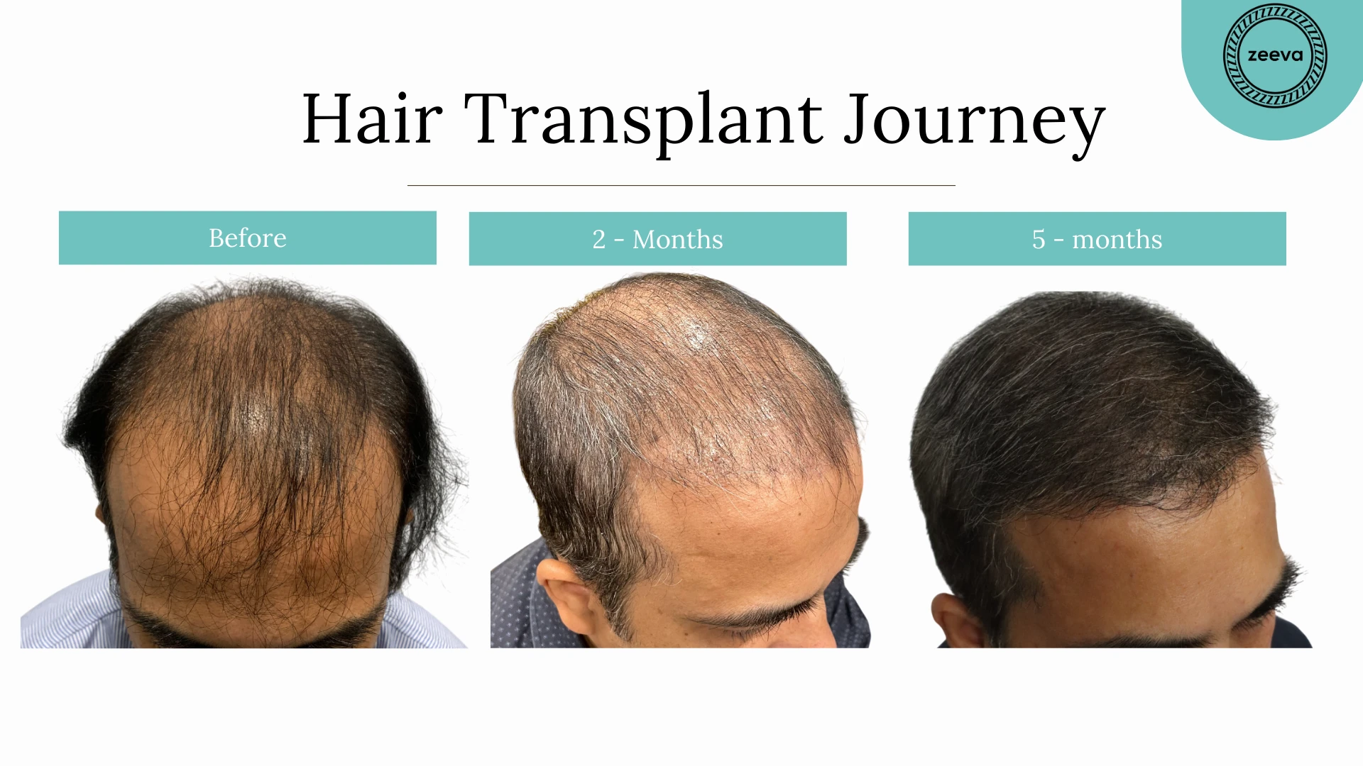Top 5 Benefits of Hair Restoration Treatment for Men and Women!