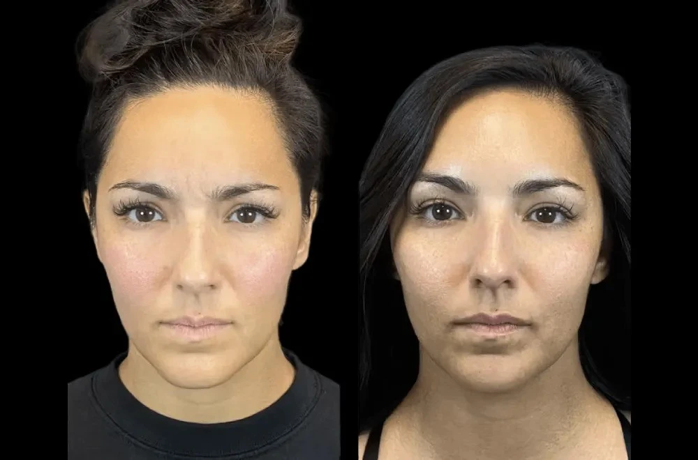 The Rise of Preventative Botox: Advice from the Best Plastic Surgeons in Dubai