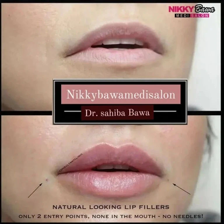 How Safe Is Lip Filler Treatment? What Aesthetic Salons Want You to Know