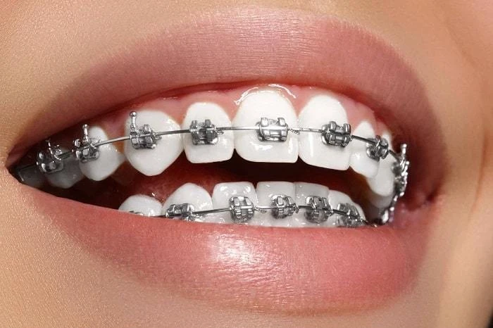 5 Myths and Facts About Dental Braces You’ve Never Known