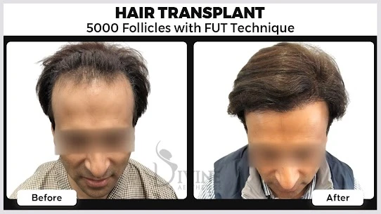 Ultimate Guide to Hair Transplant in Gurgaon & Lucknow: Cost, Clinics & Surgical Excellence by Dr. Amit Gupta