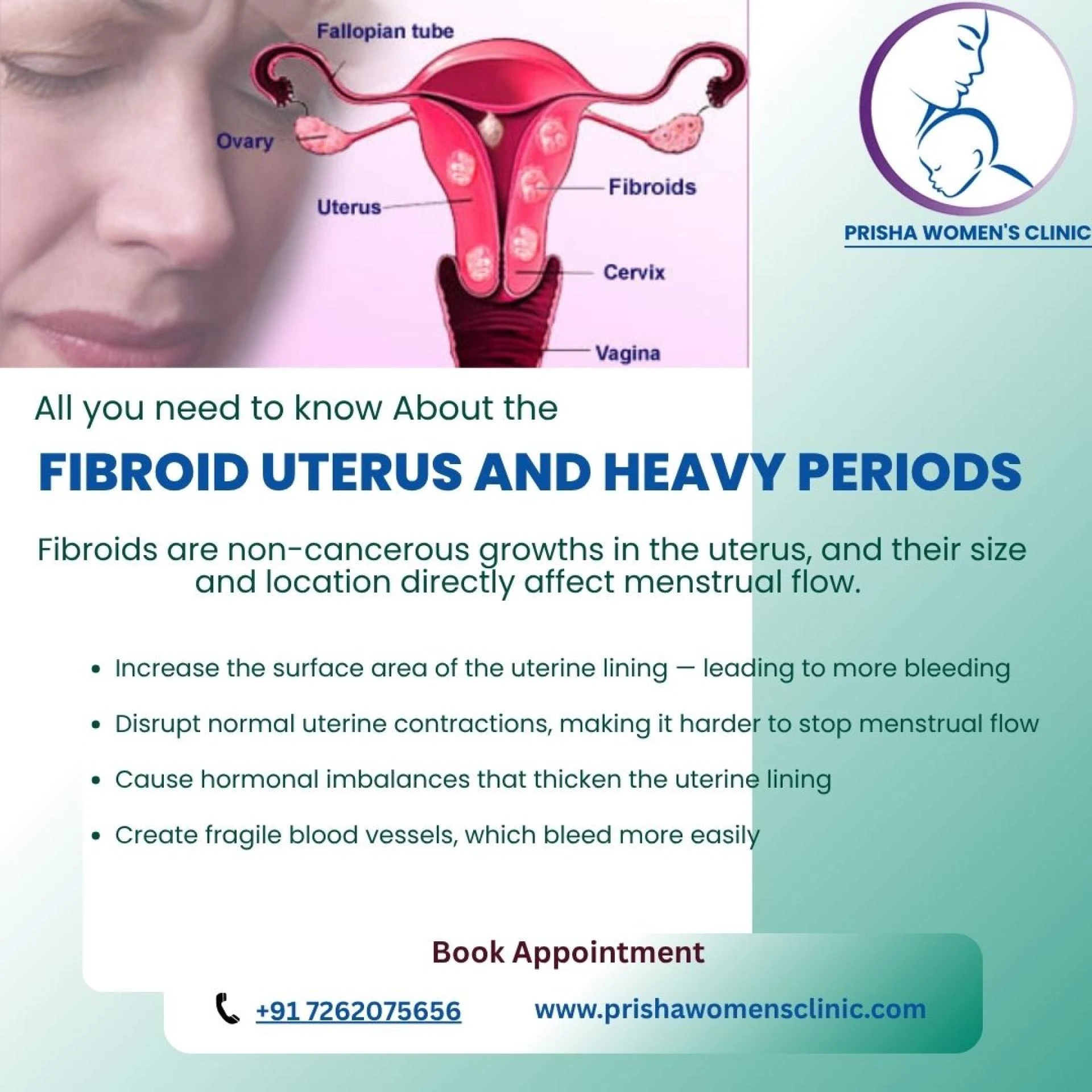 Fibroid Uterus and Heavy Periods: What’s the Connection?