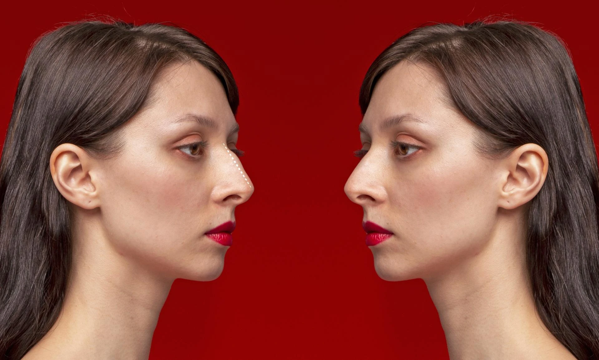 When to Choose a Nose Tip Plasty Surgery ?