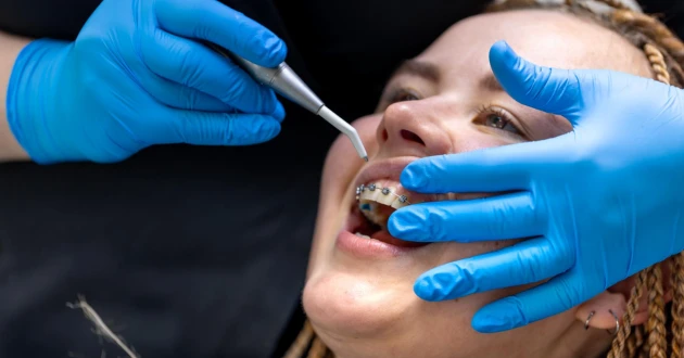 How Cosmetic dentist Bonding Fixes Cracks, Gaps, and Chips