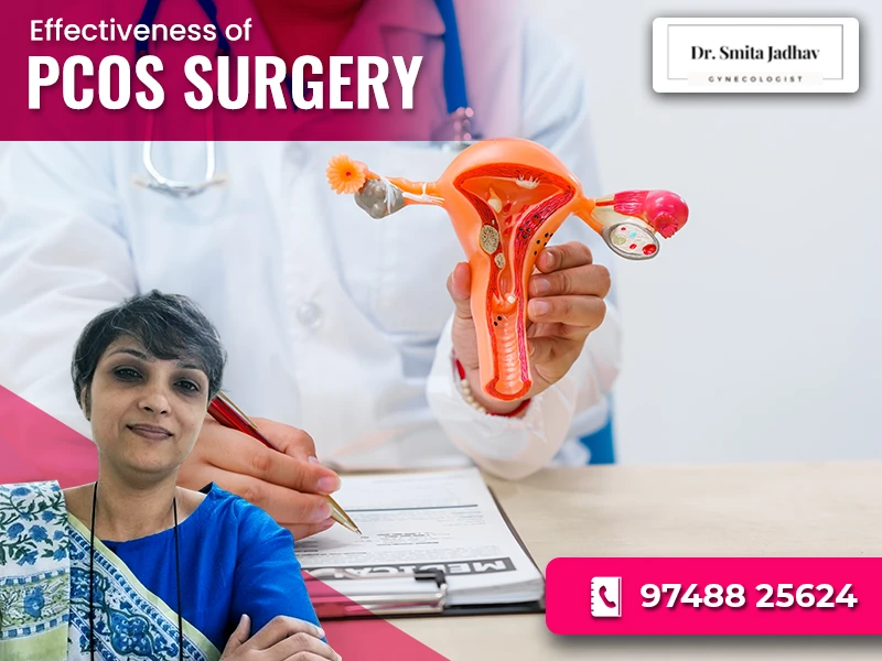 How Effective Is Surgery for PCOS? 