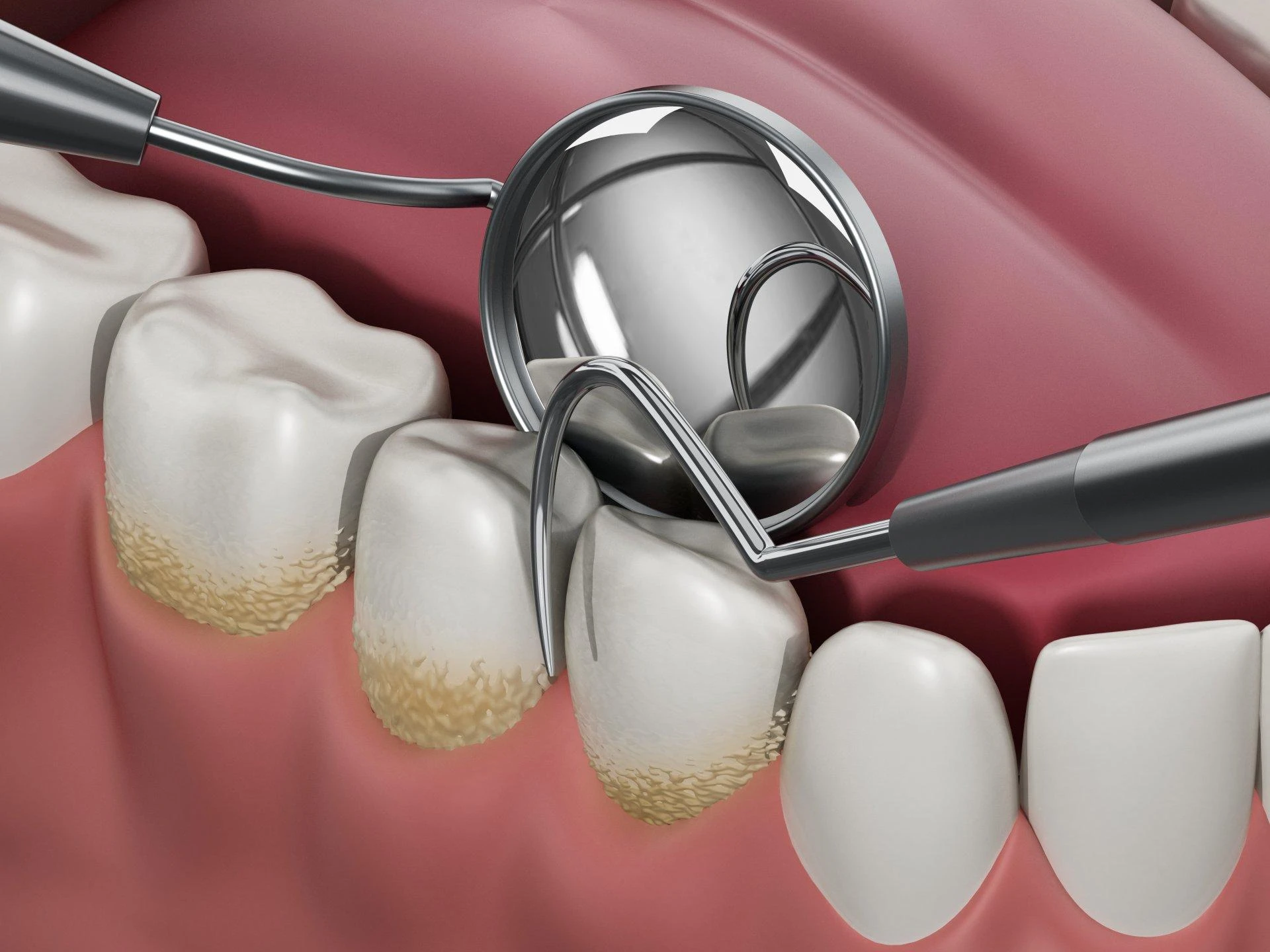 6 Facts About Dental Plaque