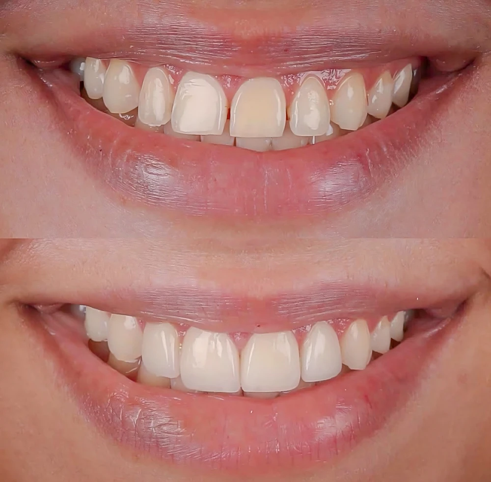 How Veneers Improve the Appearance of Teeth in Miami FL