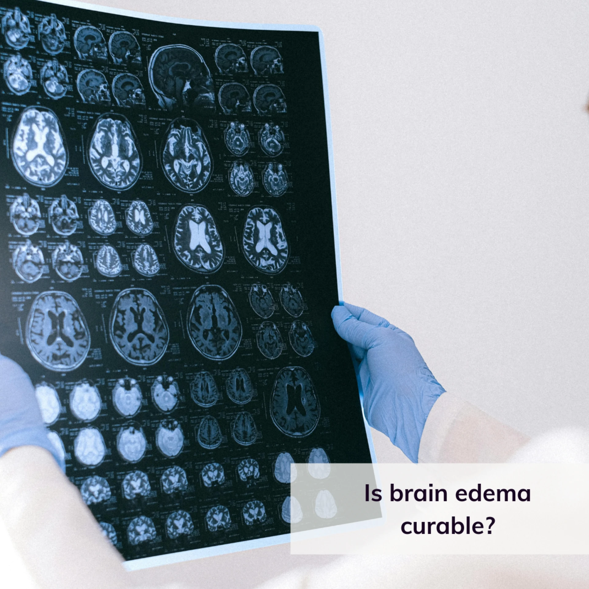 Is brain edema curable?