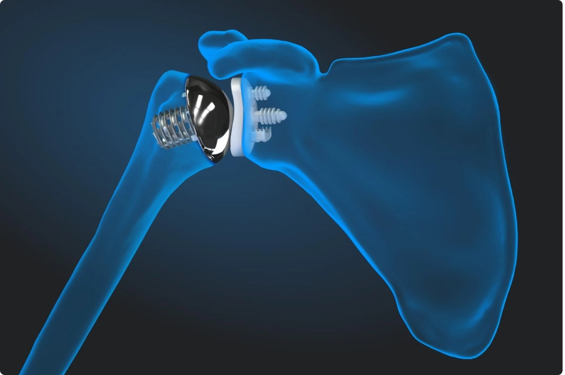 Shoulder Replacement Surgery in Delhi: A Game-Changer for Pain-Free Living