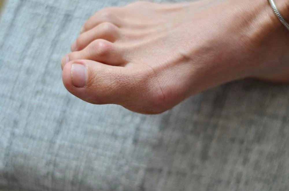 7 Ways to Fix Hammer Toes: Your Toes Deserve Better