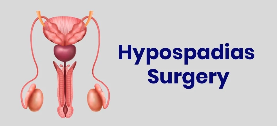 Understanding Hypospadias Surgery and Its Complications: A Guide for Parents