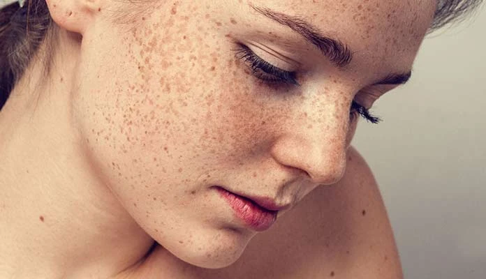 Melasma Treatment During Summer: Tips from Experts
