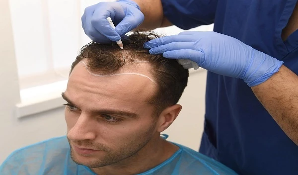 Hair Transplant for Receding Hairline in Islamabad