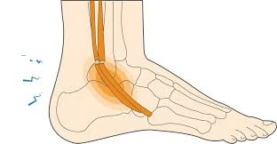 What That Persistent Ankle Pain Could Really Mean