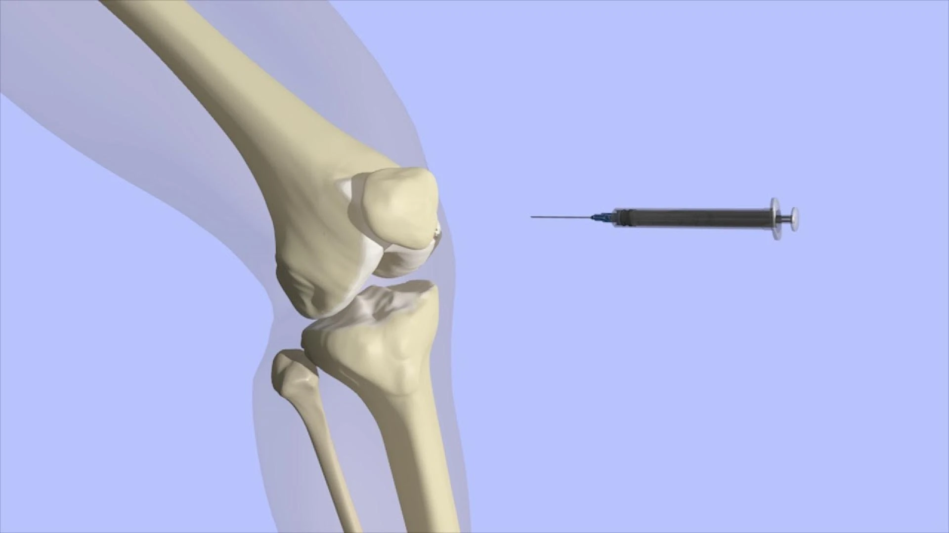 Intraarticular Joint Injections: A Breakthrough in Non-Surgical Joint Pain Relief in Delhi