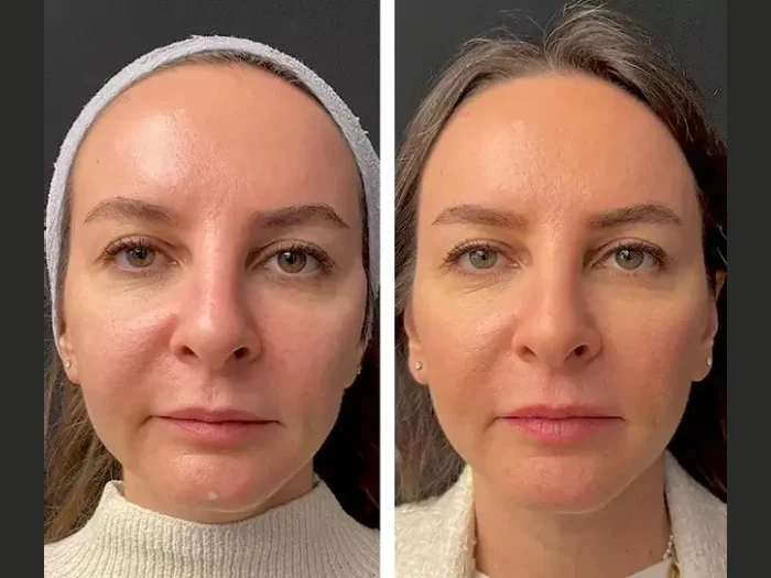 The Science Behind Mesotherapy in Dubai and Its Effectiveness