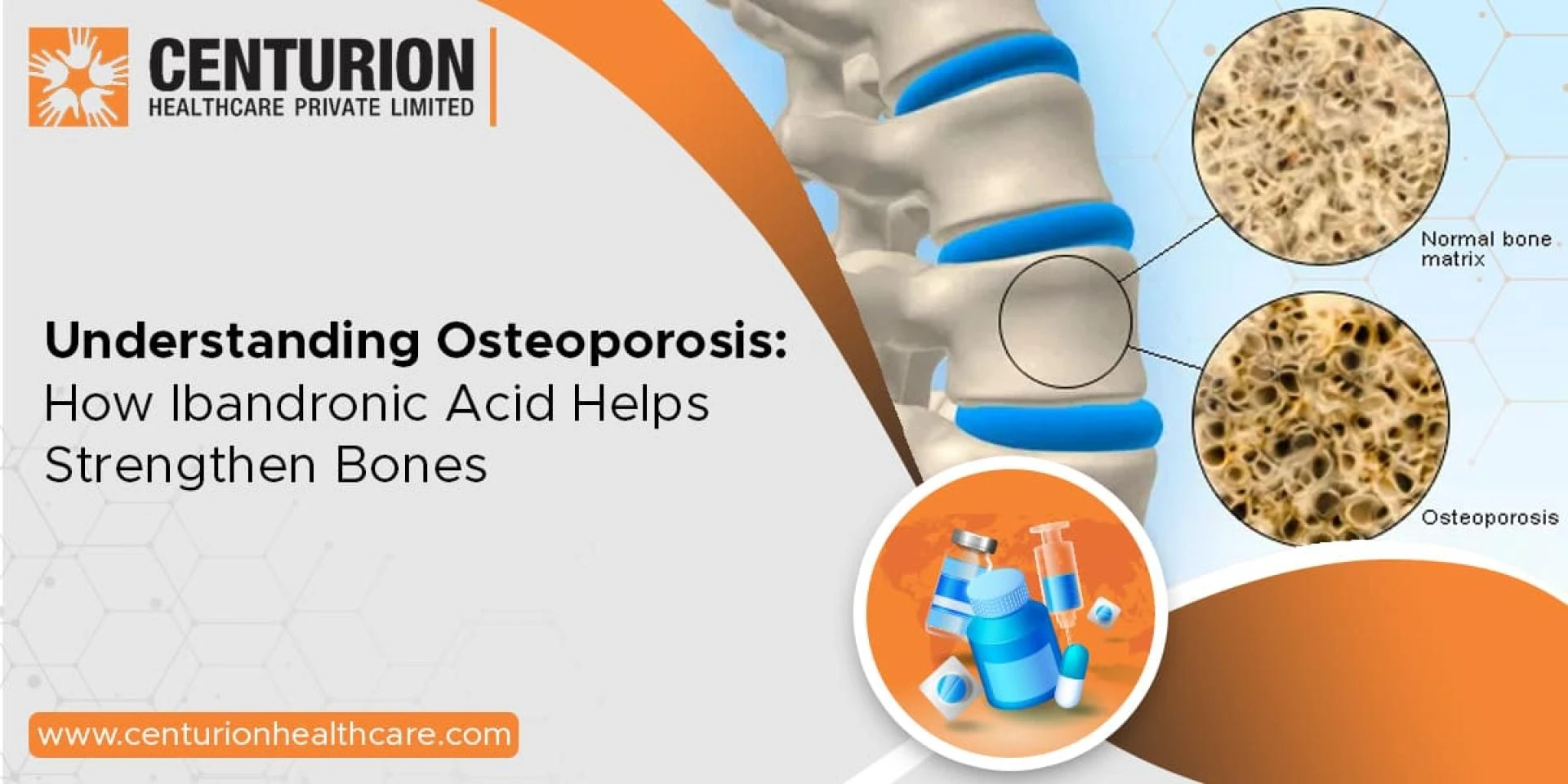 Understanding Osteoporosis How Ibandronic Acid Helps Strengthen Bones