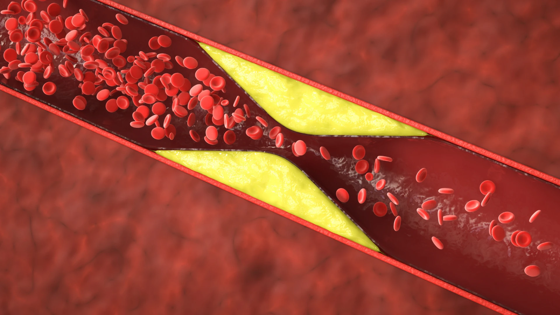 Arterial Plaque Reversal: Can You Really Unclog Your Arteries Naturally?