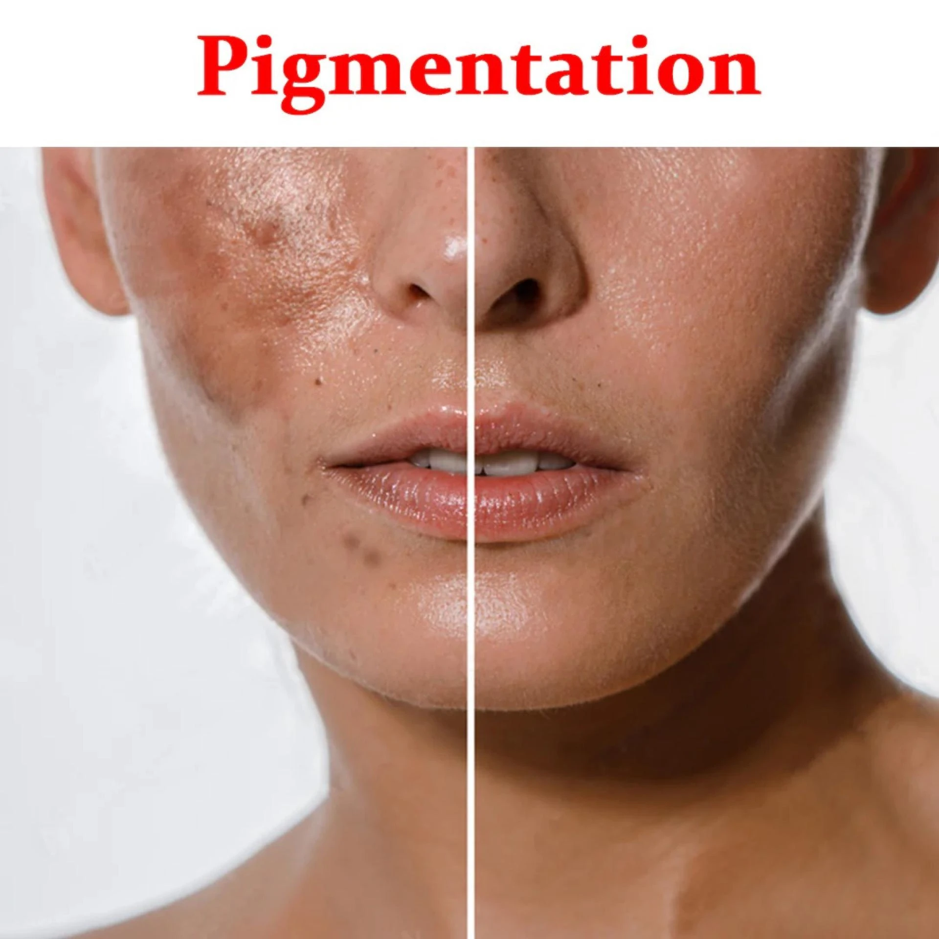 Effective Pigmentation Treatment in Delhi: How to Get the Best, Long-Lasting Results