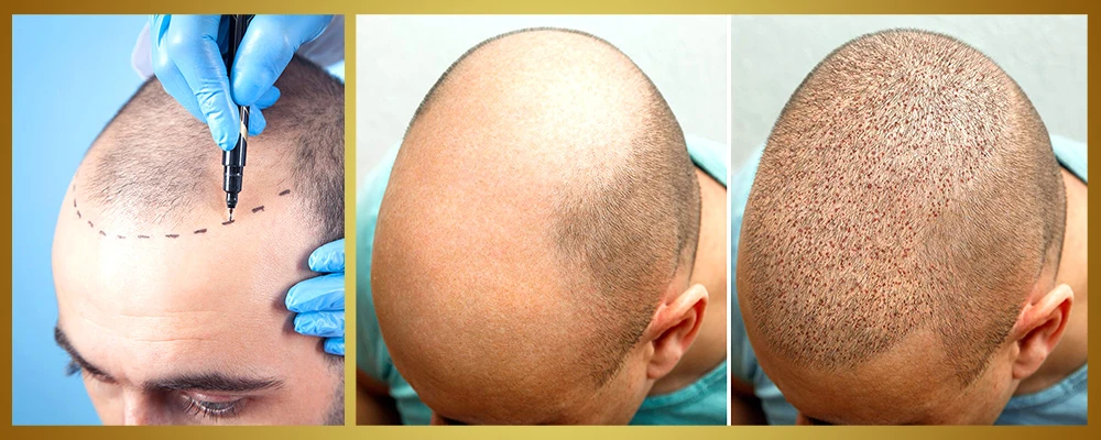 How to Choose the Best Hair Transplant Clinic and Surgeon in Delhi