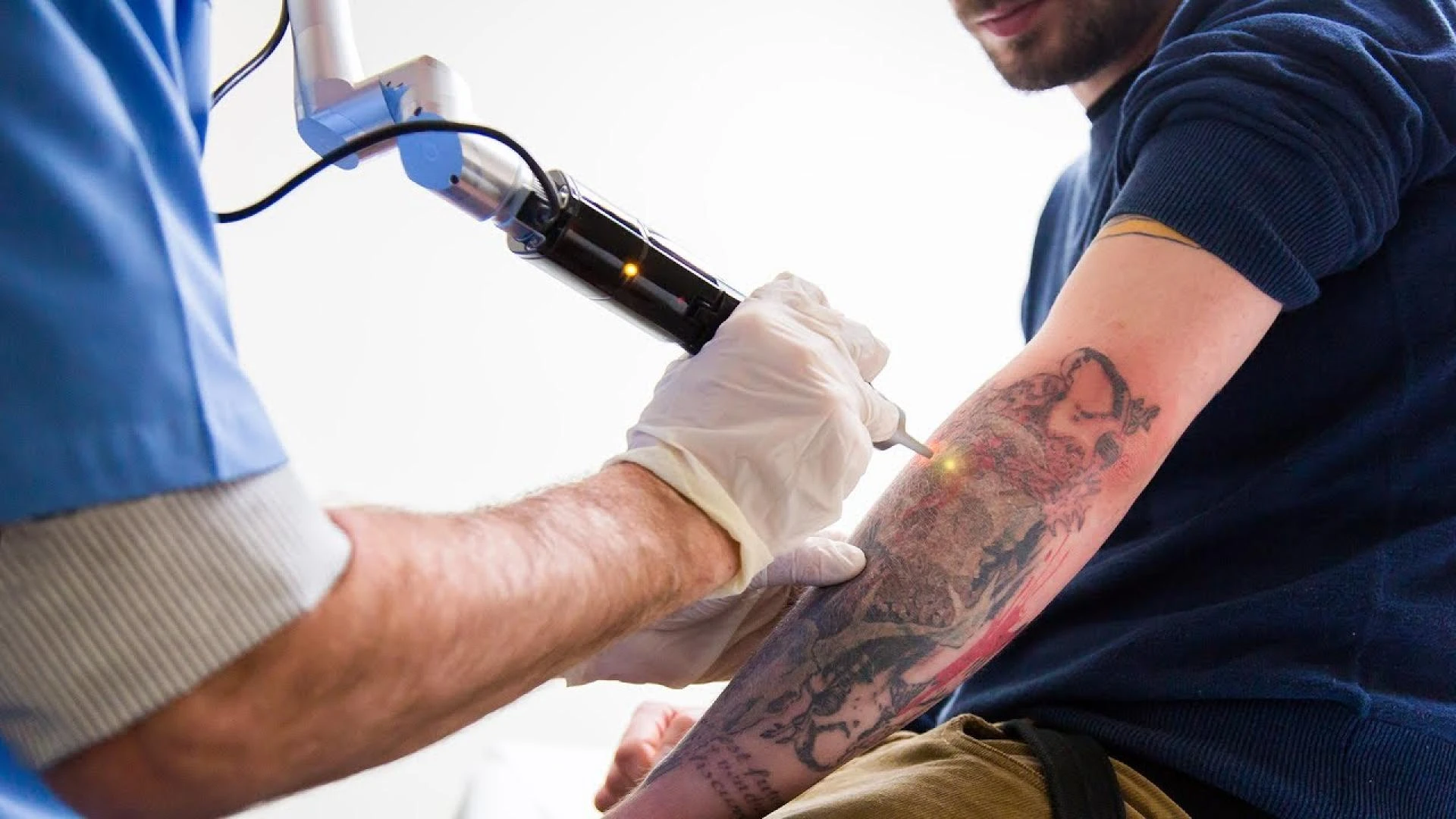 Tattoo Removal for Teens and Young Adults: Guidelines and Safety