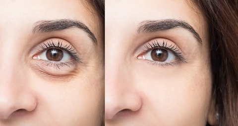 Understanding the Causes of Dark Circles Treatment with Insights from the Best Plastic Surgeon in Dubai