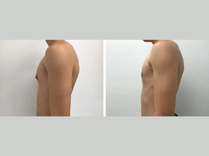 The Road to Recovery: Advice from the Best Gynecomastia Surgeon in Dubai