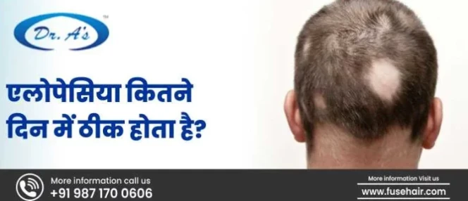 Alopecia Theek Hone Mein Kitane Din Lagate Hain | Minoxidil Kaise Kaam Karta Hain
